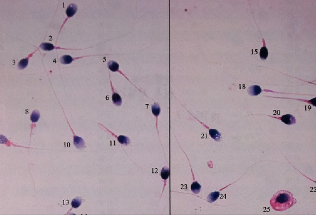 染色体+精子质量三大检查，男性孕前必查利器